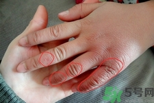 生凍瘡癢怎么辦？生凍瘡很癢的時(shí)候怎么辦？
