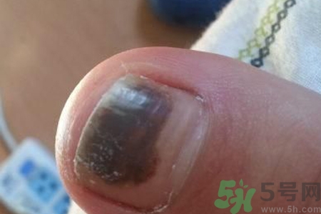 腳趾甲變黑是什么原因？腳趾甲變黑是怎么回事？