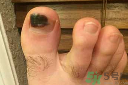 腳趾甲變黑是什么原因？腳趾甲變黑是怎么回事？