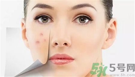 激光去痘印有效果嗎?激光祛痘會(huì)復(fù)發(fā)嗎?