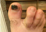 腳趾甲變黑是什么原因？腳趾甲變黑是怎么回事？
