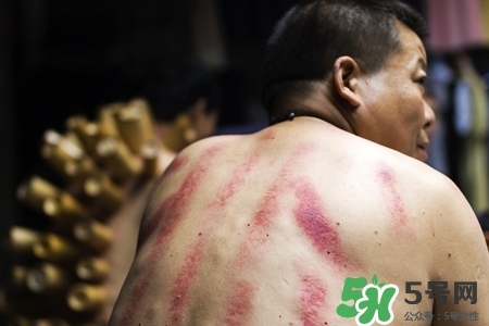 背部刮痧后能拔火罐嗎？背部刮痧后拔火罐有什么好處？