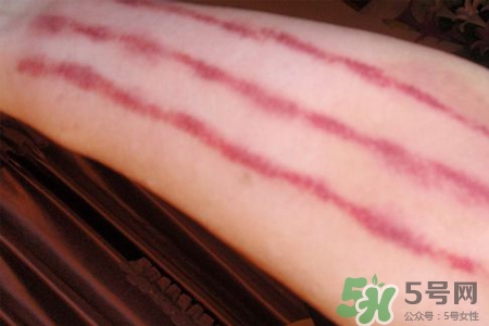 揪痧和刮痧哪個(gè)效果比較好？揪痧和刮痧的區(qū)別？