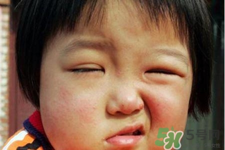 如何預(yù)防面癱復(fù)發(fā)？導(dǎo)致面癱的四大原因
