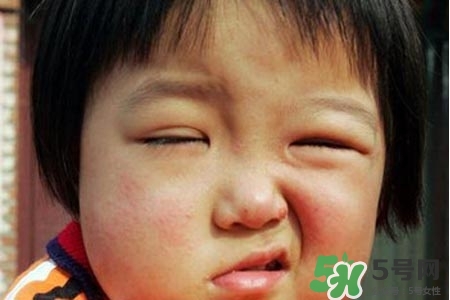 青少年面癱是怎么回事？青少年面癱是怎么辦？