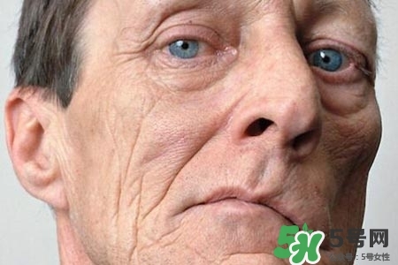 老年人為什么容易得面癱？老年人面癱原因有哪些？