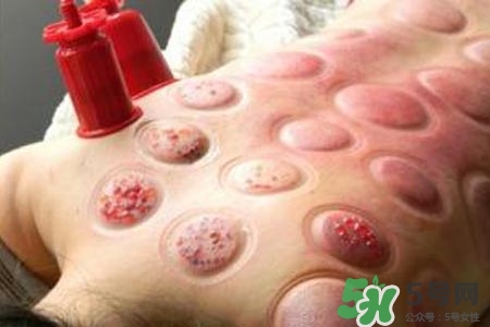 拔罐放血對身體好嗎？拔罐放血有什么好處？