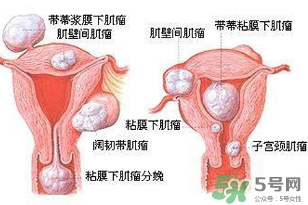 子宮小會影響生育嗎？子宮小會導致不孕嗎？