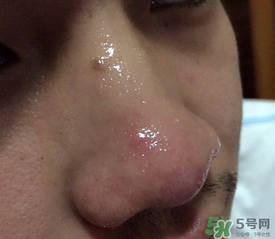 wis去黑頭套裝多少錢(qián)?wis去黑頭套裝價(jià)格