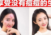 伊詩蘭頓祛痘怎么樣？伊詩蘭頓祛痘膏有用嗎？