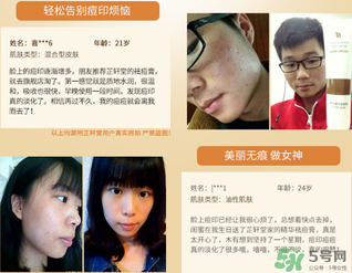芷軒堂祛痘有效果嗎？芷軒堂祛痘印效果怎么樣？