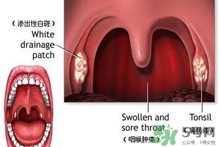 口含大蒜能治療咽炎嗎？巧用大蒜治療咽炎咳嗽