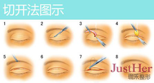 定點(diǎn)雙眼皮怎么做？定點(diǎn)雙眼皮需要拆線嗎？
