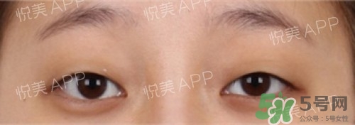 埋線雙眼皮多久恢復(fù)自然？埋線雙眼皮多久能恢復(fù)