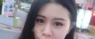 定點(diǎn)雙眼皮能保持多久？定點(diǎn)雙眼皮是永久的嗎？