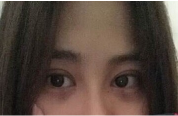 定點(diǎn)雙眼皮怎么做？定點(diǎn)雙眼皮需要拆線嗎？