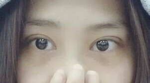 定點(diǎn)雙眼皮怎么做？定點(diǎn)雙眼皮需要拆線嗎？