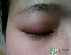 埋線雙眼皮需要拆線嗎？埋線雙眼皮怎么拆線