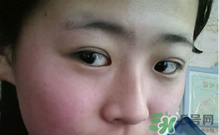 埋線雙眼皮需要拆線嗎？埋線雙眼皮怎么拆線