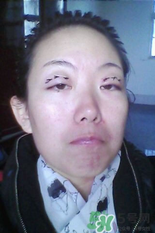 什么是定點(diǎn)雙眼皮？定點(diǎn)雙眼皮多少錢？