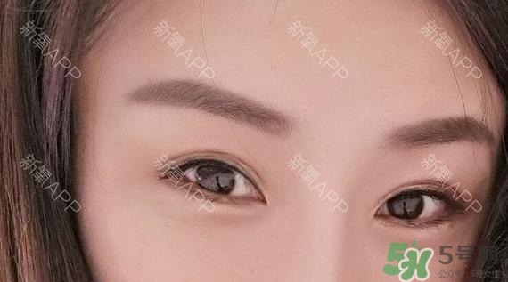 埋線雙眼皮能保持多久？埋線雙眼皮是永久嗎