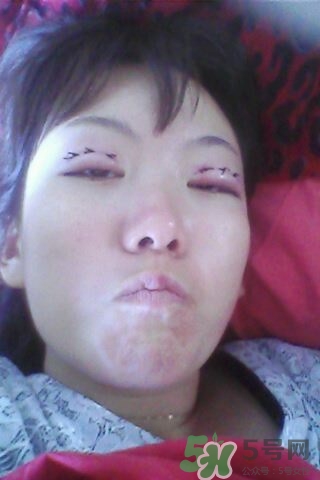 什么是定點(diǎn)雙眼皮？定點(diǎn)雙眼皮多少錢？