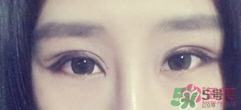 切開雙眼皮多久消腫？切開雙眼皮多久恢復？