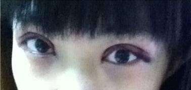 韓式三點(diǎn)雙眼皮是永久嗎？三點(diǎn)雙眼皮能保持多久？