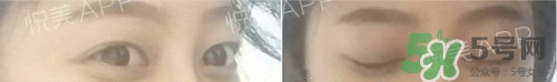埋線雙眼皮多久恢復(fù)自然？埋線雙眼皮多久能恢復(fù)