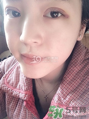 什么是定點(diǎn)雙眼皮？定點(diǎn)雙眼皮多少錢？