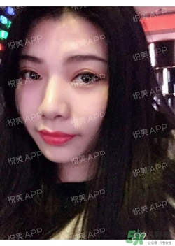切開雙眼皮消腫過程圖_切開雙眼皮恢復過程圖