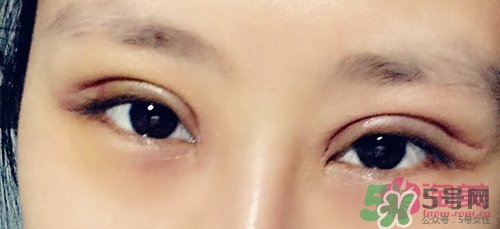 切開雙眼皮多久消腫？切開雙眼皮多久恢復？