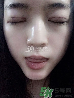 什么是定點(diǎn)雙眼皮？定點(diǎn)雙眼皮多少錢？