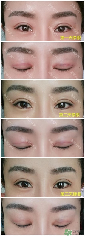 埋線雙眼皮能保持多久？埋線雙眼皮是永久嗎