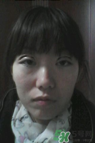 什么是定點(diǎn)雙眼皮？定點(diǎn)雙眼皮多少錢？