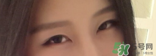 切開雙眼皮多久消腫？切開雙眼皮多久恢復？