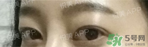 埋線雙眼皮多久恢復(fù)自然？埋線雙眼皮多久能恢復(fù)