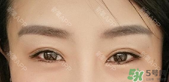 埋線雙眼皮能保持多久？埋線雙眼皮是永久嗎