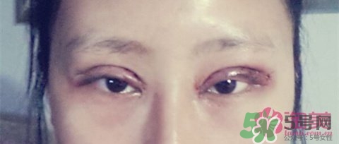切開雙眼皮多久消腫？切開雙眼皮多久恢復？