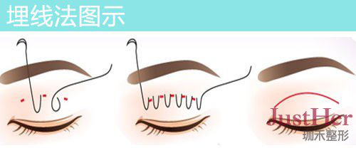 定點(diǎn)雙眼皮怎么做？定點(diǎn)雙眼皮需要拆線嗎？
