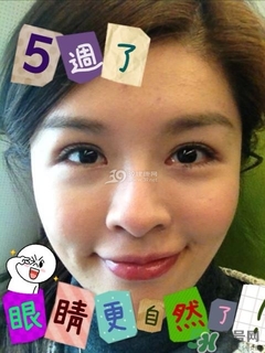 重瞼術(shù)是什么？重瞼術(shù)是永久的嗎？