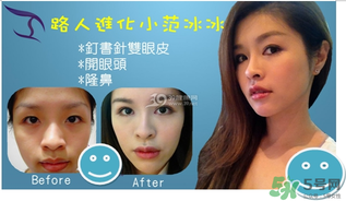 重瞼術(shù)是什么？重瞼術(shù)是永久的嗎？