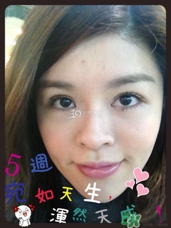 重瞼術(shù)是什么？重瞼術(shù)是永久的嗎？