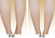 小腿吸脂多久見效？小腿吸脂后多久能看見效果？