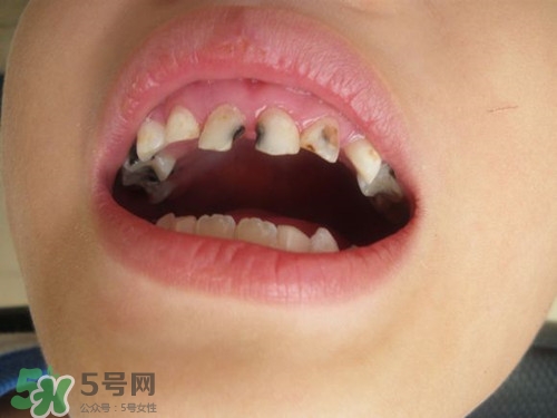 小孩換牙半年還沒長(zhǎng)出來是怎么回事?小孩換牙注意事項(xiàng)