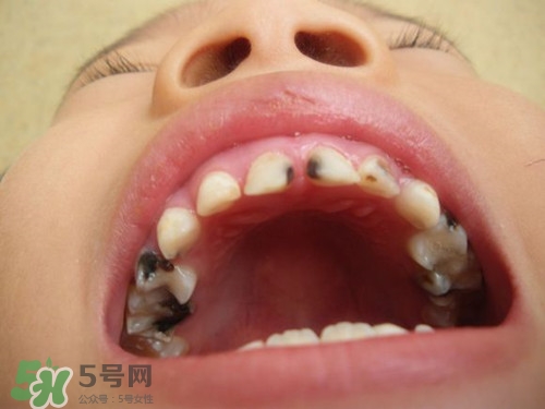 小孩換牙半年還沒長(zhǎng)出來是怎么回事?小孩換牙注意事項(xiàng)