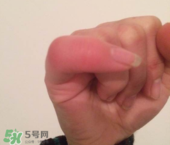 小拇指凍腫了怎么辦？為什么小拇指容易凍？