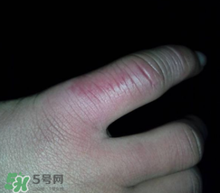 小拇指凍腫了怎么辦？為什么小拇指容易凍？