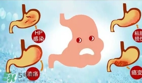 神經(jīng)性胃痙攣是什么？神經(jīng)性胃痙攣是什么原因？