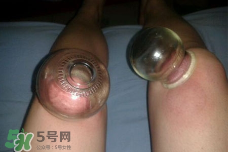 小腿能拔罐嗎？在小腿上拔火罐有什么作用？